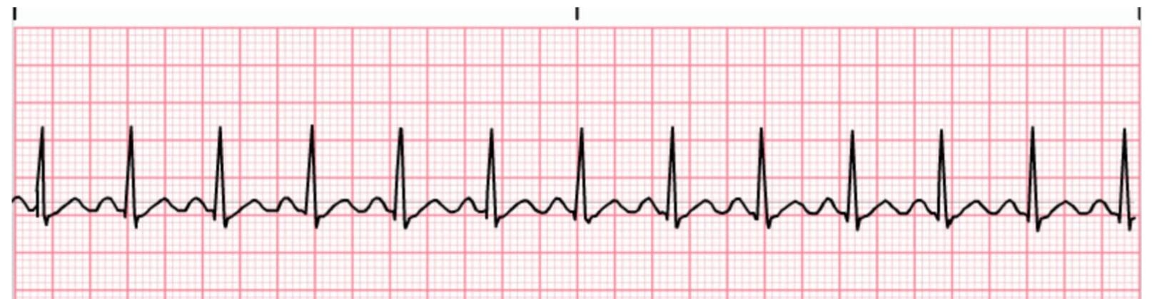 <p>The Registered Nurse is caring for a patient and notes the following rhythm on the cardiac monitor. The nurse correctly identifies this rhythm as:</p>