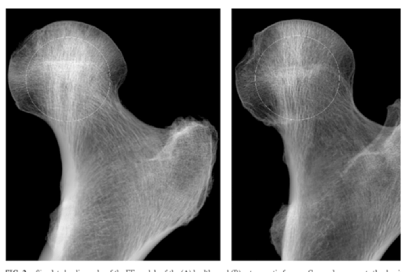 <p>A decrease in bone density may indicate osteoporosis</p><p>**be careful in distinguishing osteoporosis from what normally looks radiolucent (i.e., it is normal for trabecular bone to be less dense than cortical bone)**</p>