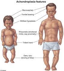 <ul><li><p>macrocephaly</p></li><li><p>prominent forehead </p></li><li><p>short limbs &amp; fingers </p></li><li><p>disproportionate short stature  </p></li></ul>