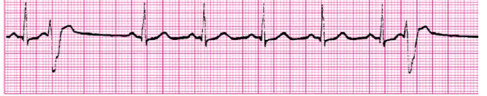 <p>assess BP, change in LOC, breathing, chest pain</p><p>Asx - monitor, treat underlying cause (hypoxia, electrolytes, HF, MI, post CABG, reperfusions, catheters in RV, anxiety, caffeine/stimulants)</p><p>DO NOT COUNT PVCs IN HR COUNT</p>
