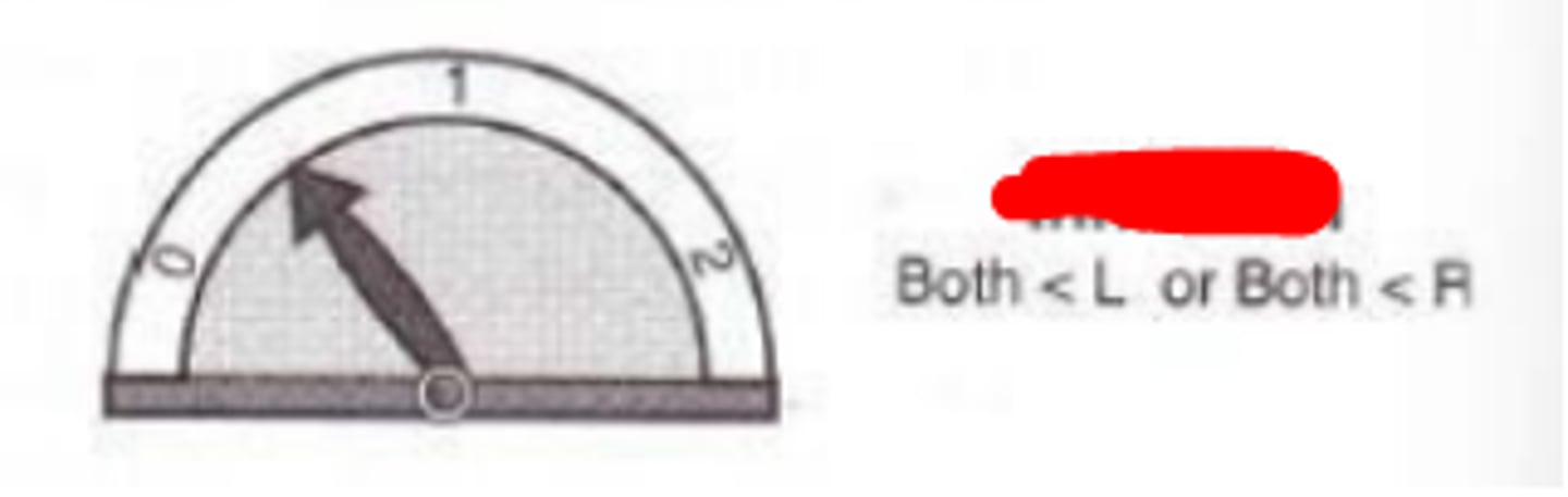 <p>degree of binocular summation where the performance of one eye is degraded by the other eye, and the binocular visual performance with both eyes is less than the monocular visual performance.</p>