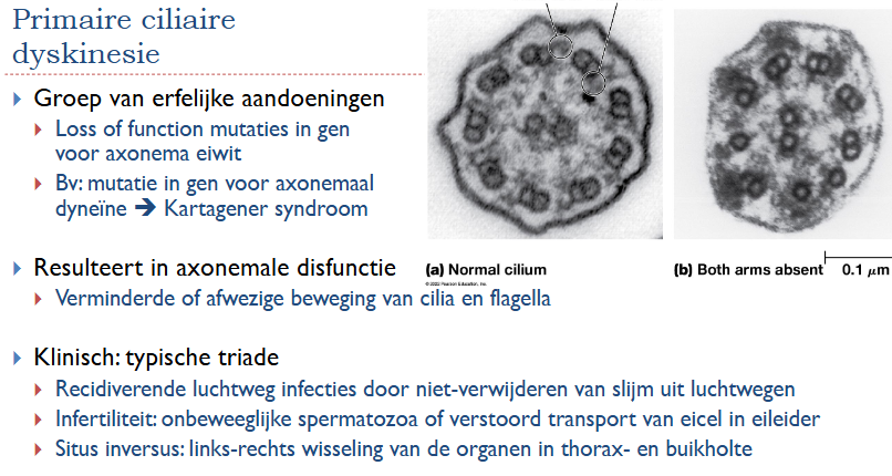 <ul><li><p>Groep van erfelijke aandoeningen</p><ul><li><p>Loss of function mutaties in gen van axonema eiwit</p></li><li><p>Bv: mutatie in gen voor axonemaal dyneïne → Kartagener syndroom</p></li></ul></li><li><p>Resulteert in axonemale disfunctie</p><ul><li><p>Verminderde of afwezige beweging van cilia en flagella </p></li></ul></li><li><p>Klinisch: typische triade</p><ul><li><p>Luchtweginfecties door niet verwijderen slijm uit luchtwegen</p></li><li><p>Infertitliteit: onbeweeglijke spermatozoa of verstoord transport van eicel in eileider</p></li><li><p>Situs inversus: links-rechts wisseling van de organen in thorax- en buikholte</p></li></ul></li></ul><p></p>