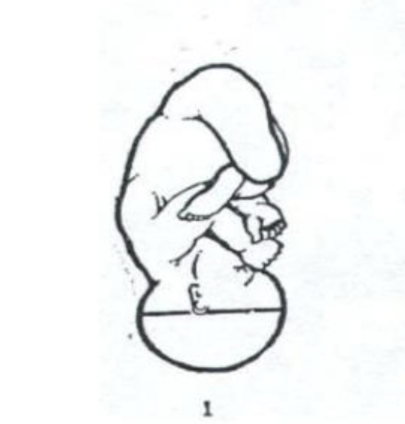 <p>most common and ideal presentation for vaginal birth;<strong> head fully flexed, with the chin tucked to the chest</strong>; allows the smallest diameter of the fetal head to pass through the pelvis</p>