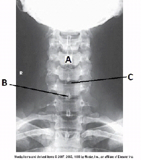 <p><span>What is the projection and anatomy of interest in the figure below?</span></p>