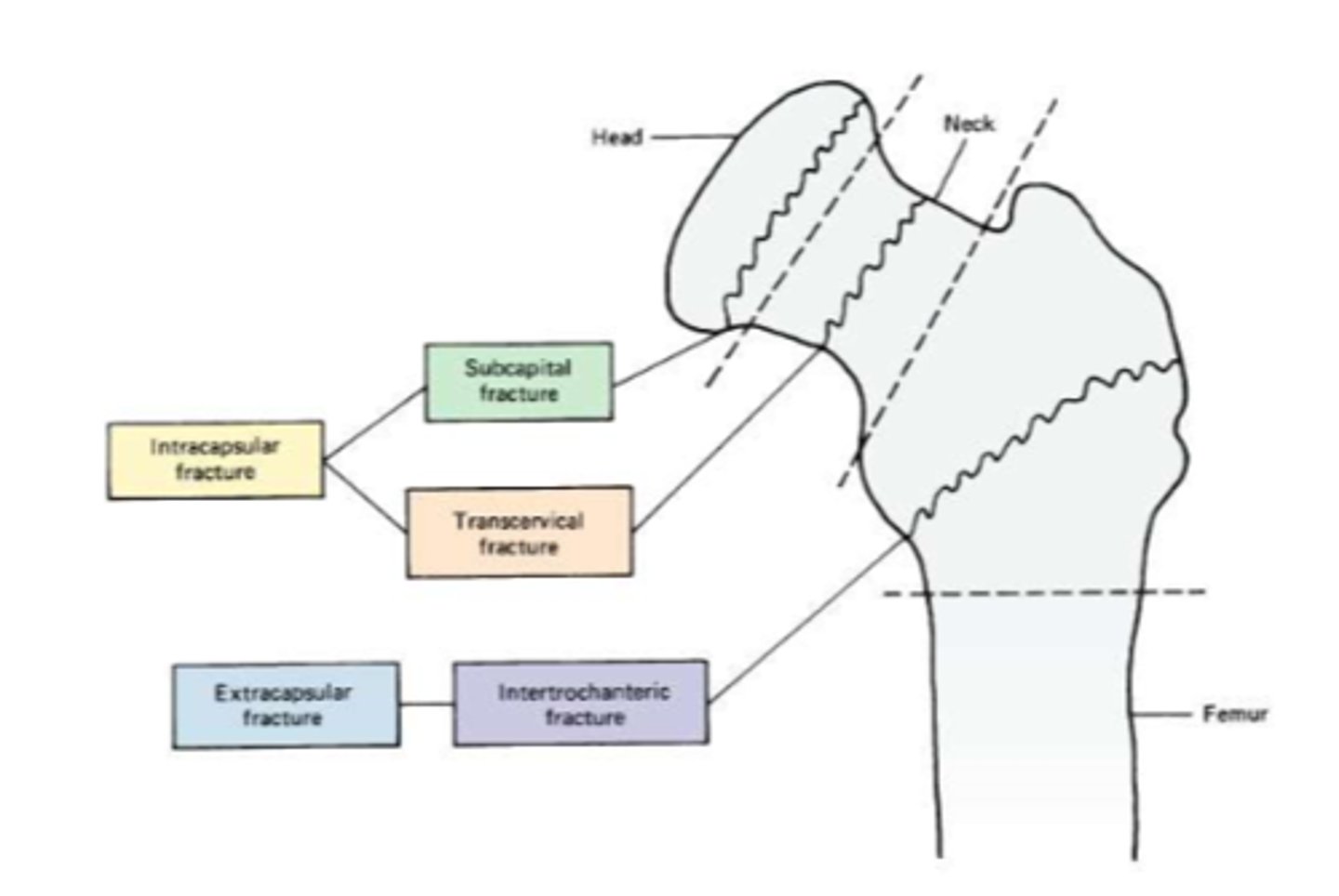 <p>associated with decreased bone density and falls in the elderly (av. age 70)</p><p>females &gt; males</p><p>STRUCTURES:</p><p>1. femoral neck/subcapital</p><p>2. intertrochanteric</p><p>FUNCTIONAL DEFICITS--&gt; pain, difficultly or inability to ambulate, rotational deformity</p><p>COMPENSATORY MOVEMENTS--&gt; LE will shorten and ER</p><p>*if able to ambulate, will present with decreased step length of the opposite side</p>