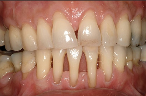 <p>It becomes swollen and blunted. As this happens, the original shape is lost, and it tends to get more irritated when eating, causing more problems. Shows a breakdown of the supporting structures that hold teeth in place. The images below show extensive disease in the supporting tissues as well as bone loss. </p>