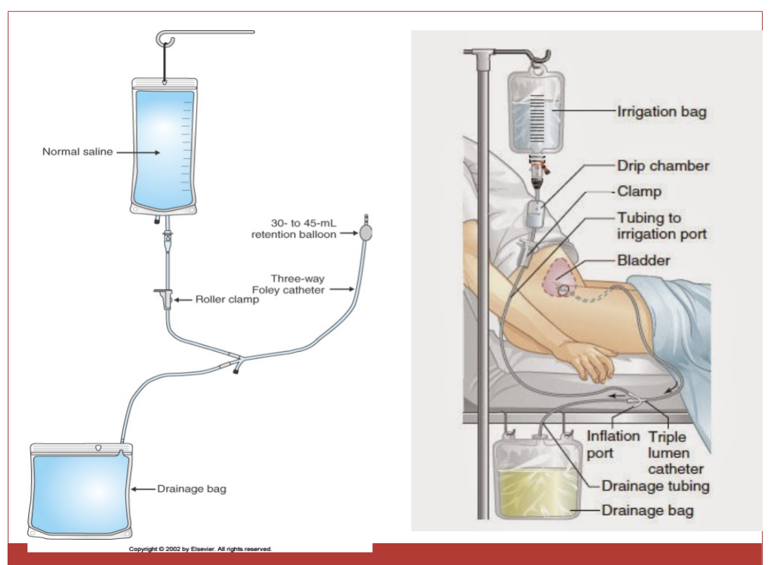 <p>to continuously flush the bladder, prevent clots, and keep urine flowing freely.</p>