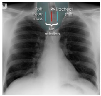 <p>tracheal displacement </p>