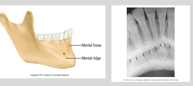 <p><span><span>·</span></span><span style="font-family: "Times New Roman"; line-height: normal; font-size: 7pt;"><span> </span></span><span><span>A linear prominence of cortical bone located on the external surface of the anterior portion of the mandible</span></span></p><p class="MsoListParagraphCxSpMiddle"><span><span>·</span></span><span style="font-family: "Times New Roman"; line-height: normal; font-size: 7pt;"><span> </span></span><span><span>Often appears superimposed over the mandibular anterior teeth</span></span></p><p class="MsoListParagraphCxSpLast"><span><span>·</span></span><span style="font-family: "Times New Roman"; line-height: normal; font-size: 7pt;"><span> </span></span><span><span>A thick radiopaque band that extends from the premolar region to the incisor region</span></span></p>