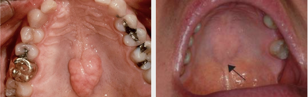 <p>Exophytic growth of normal compact bone on hard palate</p>