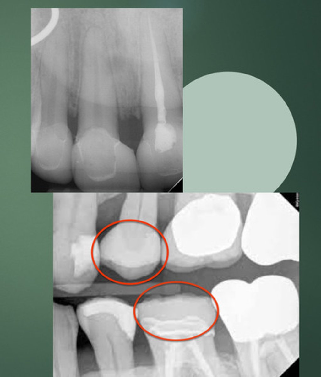 <p>Lithium disilicate is Less bright than</p><p>__ (metal alloy)</p>