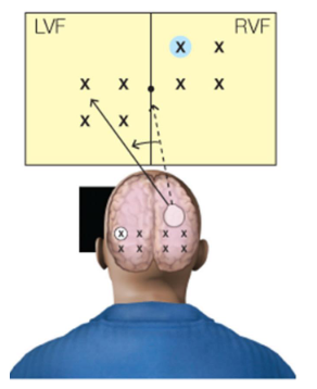 <p>• participants fixate on points located between two four-point grids → one of four points is briefly highlighted</p>
<p>• participants are asked to move eyes to corresponding point in <strong>other</strong> visual field → participants perfectly able to do this </p>
<p>• indicates type of spatial information is being transferred or integrated between 2 hemispheres</p>
<p>• conclusion: orienting attention appears to be undivided, attentional resources are shared, but difference in how attention is used by different hemispheres could be present</p>