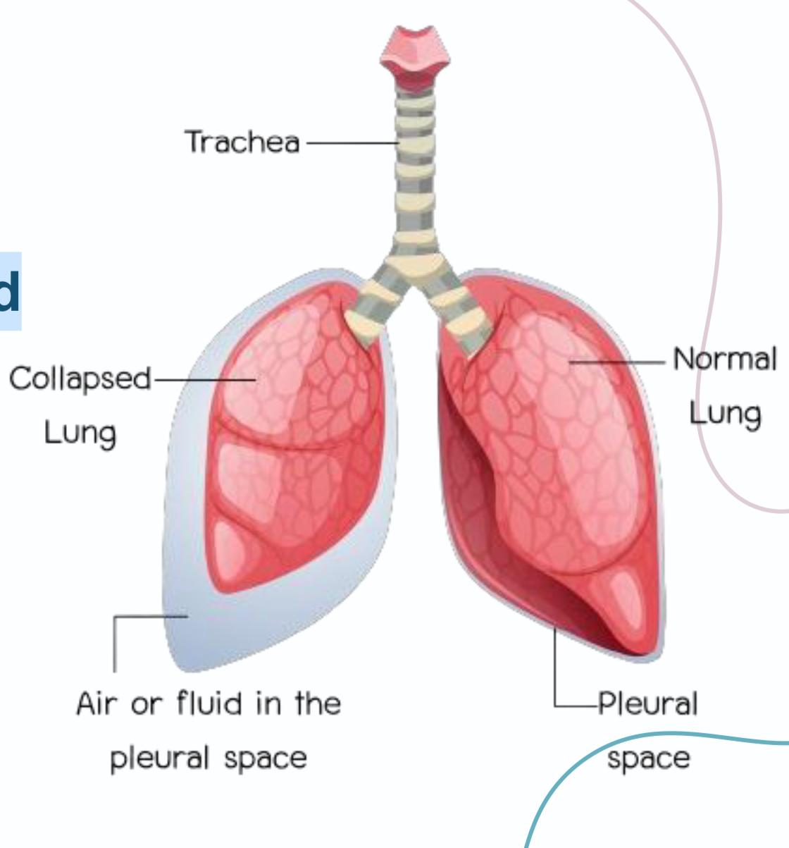 <p><span>Presence of air between visceral and</span></p><p><span>parietal pleura that leads to lung</span></p><p><span>collapse.</span></p>