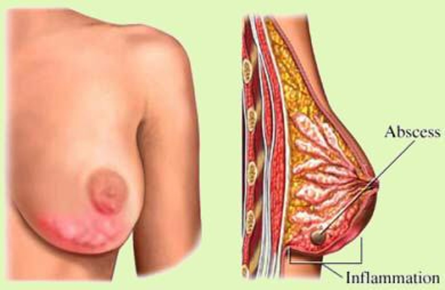 <ul><li><p>firm erythematous in lighter skin</p></li><li><p>darker area on darker skin</p></li><li><p>tender, swollen area</p></li><li><p>occurs in breastfeeding</p></li><li><p>caused by engorgement and obstruction of milk drainage of a lactating person</p></li><li><p>presents with flu-like symptoms associated</p></li></ul><p></p>