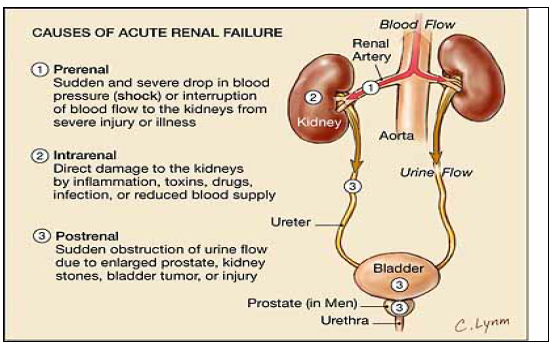 <p>Three categories of AKI:</p><ul><li><p>Pre-renal (40-80% of cases)</p><ul><li><p>diseases characterized by renal hypo perfusion in which the integrity of renal parenchymal tissue is preserved</p></li></ul></li><li><p>Intra-renal or intrinsic (10-50% of cases)</p><ul><li><p>diseases involving renal parenchymal tissue</p></li></ul></li><li><p>Post-renal or obstructive (&lt;10% of cases)</p><ul><li><p>diseases associated with acute obstruction of the urinary tract (i.e. ureters, urethra etc)</p></li></ul></li></ul><p></p>