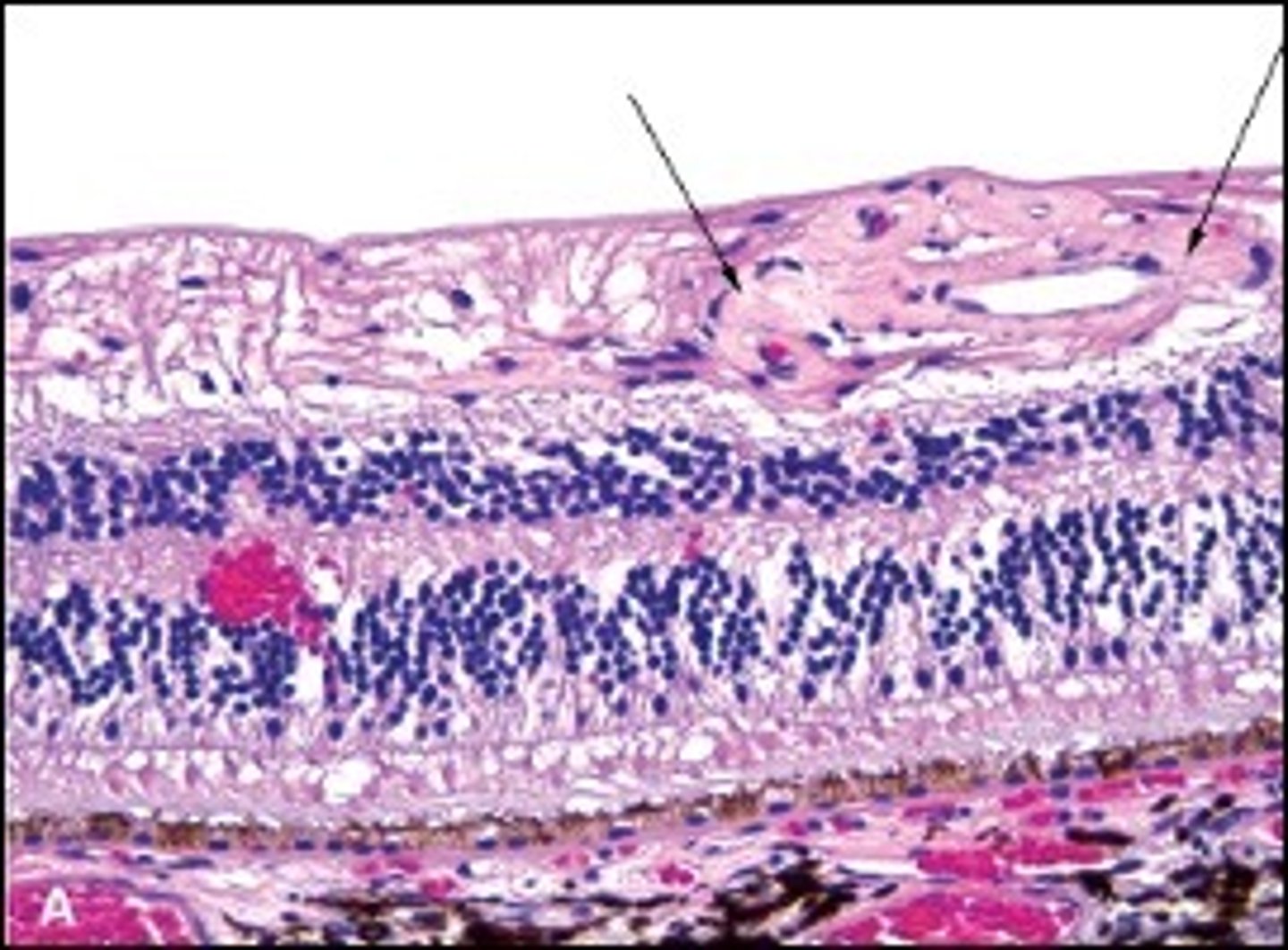 <p>Describe Nonproliferative Diabetic Retinopathy</p>