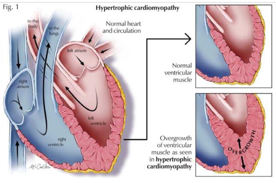 <ul><li><p><span><span>A sign of being “overworked”. </span></span></p></li><li><p><span><span>The heart muscle will respond and hypertrophy (increase in size) just like your skeletal muscle would respond to weight-lifting.</span></span></p></li><li><p><span><span>The Good (“Normal”): Athlete's heart – an appropriate adaptation! Occurs in both endurance athletes and weightlifters!</span></span></p></li><li><p><span><span>The Bad: Causes include high blood pressure and narrowing of<br>aortic valve ... the heart must work harder to overcome these adaptations</span></span></p></li><li><p><span><span>Example: In individuals who have obesity. Sometimes they will present with this cardiac hypertrophy, but in this case, it is considered a negative adaptation that can have poor consequences on their health</span></span></p></li></ul><p></p>