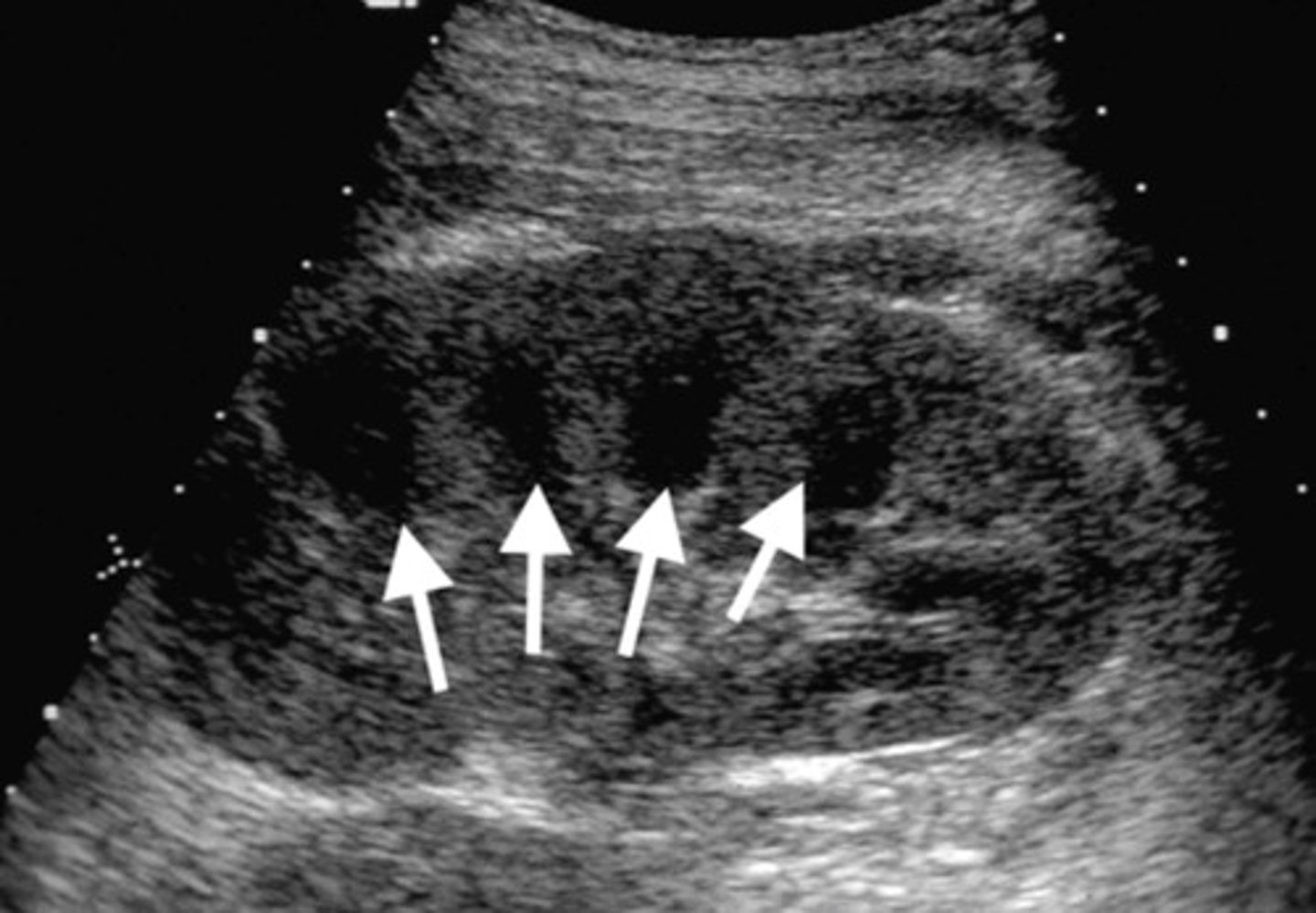 <p>Enlarged kidney</p><p>Loss of corticomedullary boarders</p>