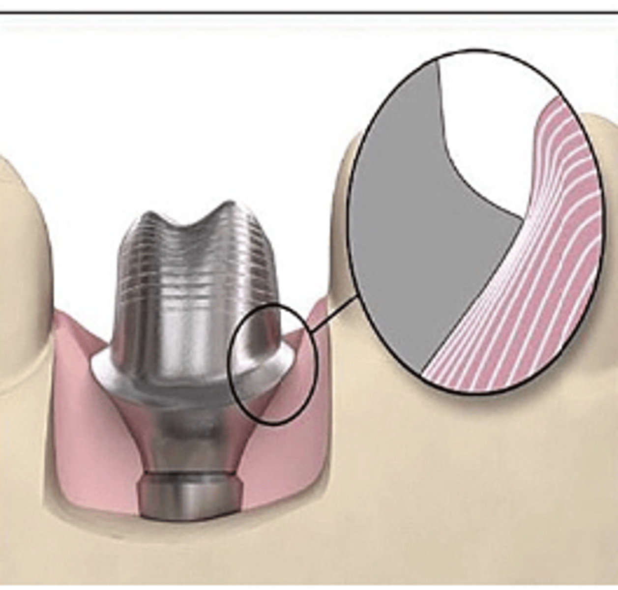 <p>What type of abutment?</p><p>- Larger-diameter abutment provided with the best emergence profile possible</p><p>- Surgical incision for placement may be required</p>