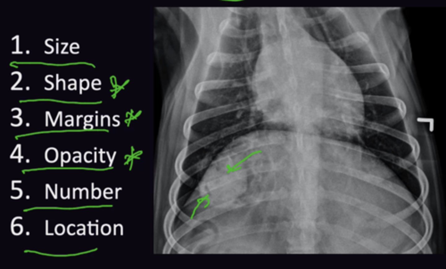 <p>1. A list of adjectives to describe abnormalities, they are prompts for how to describe the appearance of the radiographic abnormality</p><p>2. Size, Shape, Margins, Opacity, Number, Location</p><p>3. For each structure ask if it is normal or abnormal</p><p>→ Normal → Move on</p><p>OR</p><p>→ Abnormal → Evaluate using Roentgen Signs</p>