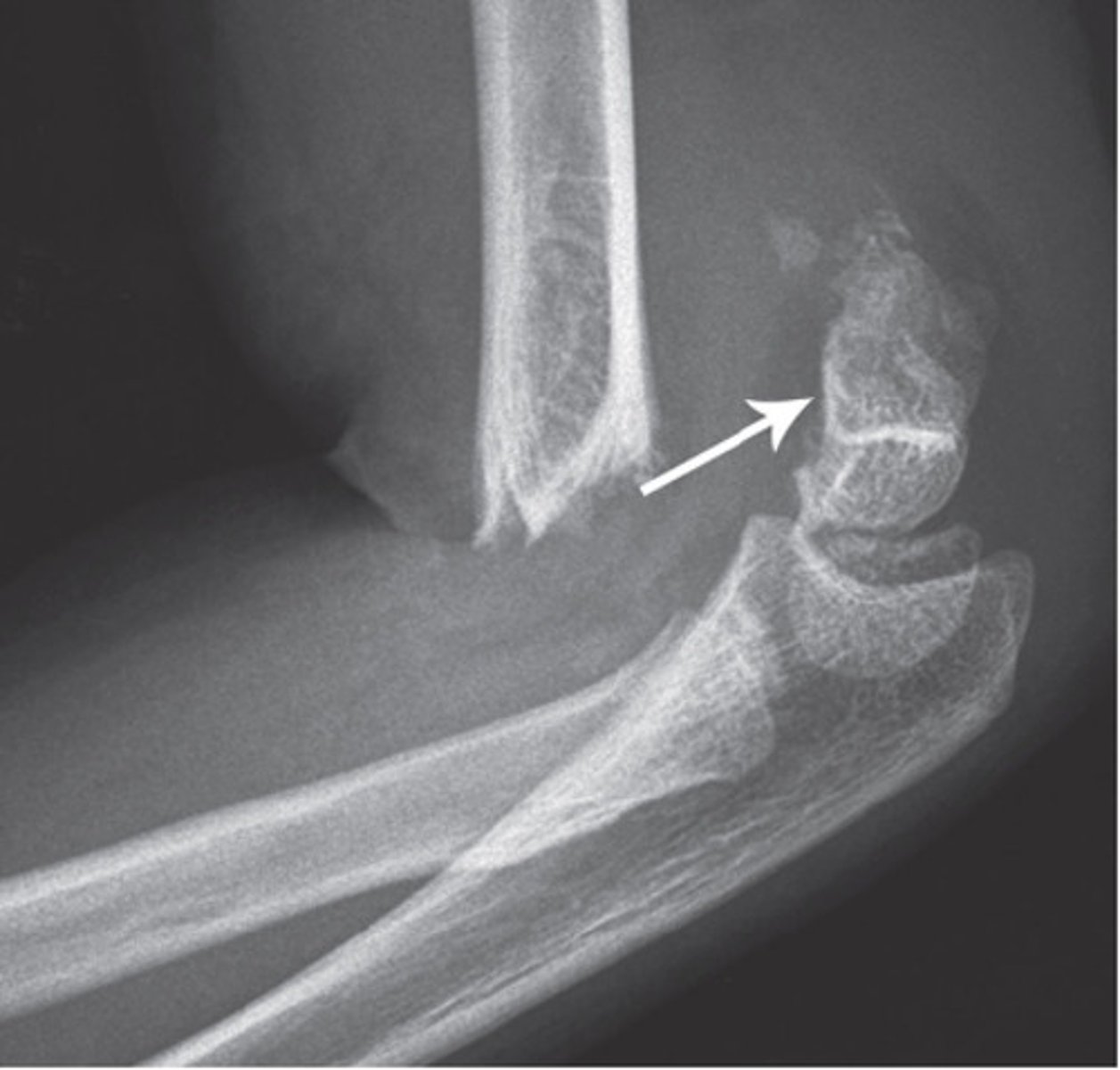 <p>distal humeral fracture</p><p>common in kids</p><p>typically AIN (branch of median nerve) and brachial artery involvement</p><p>complications: volkmanns ischemic contracture, gun stock deformity (reduced carrying angle), high incidence of malunion</p><p>requires ORIF</p>