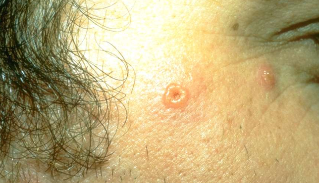 <p>Welke infectie is dit? </p>