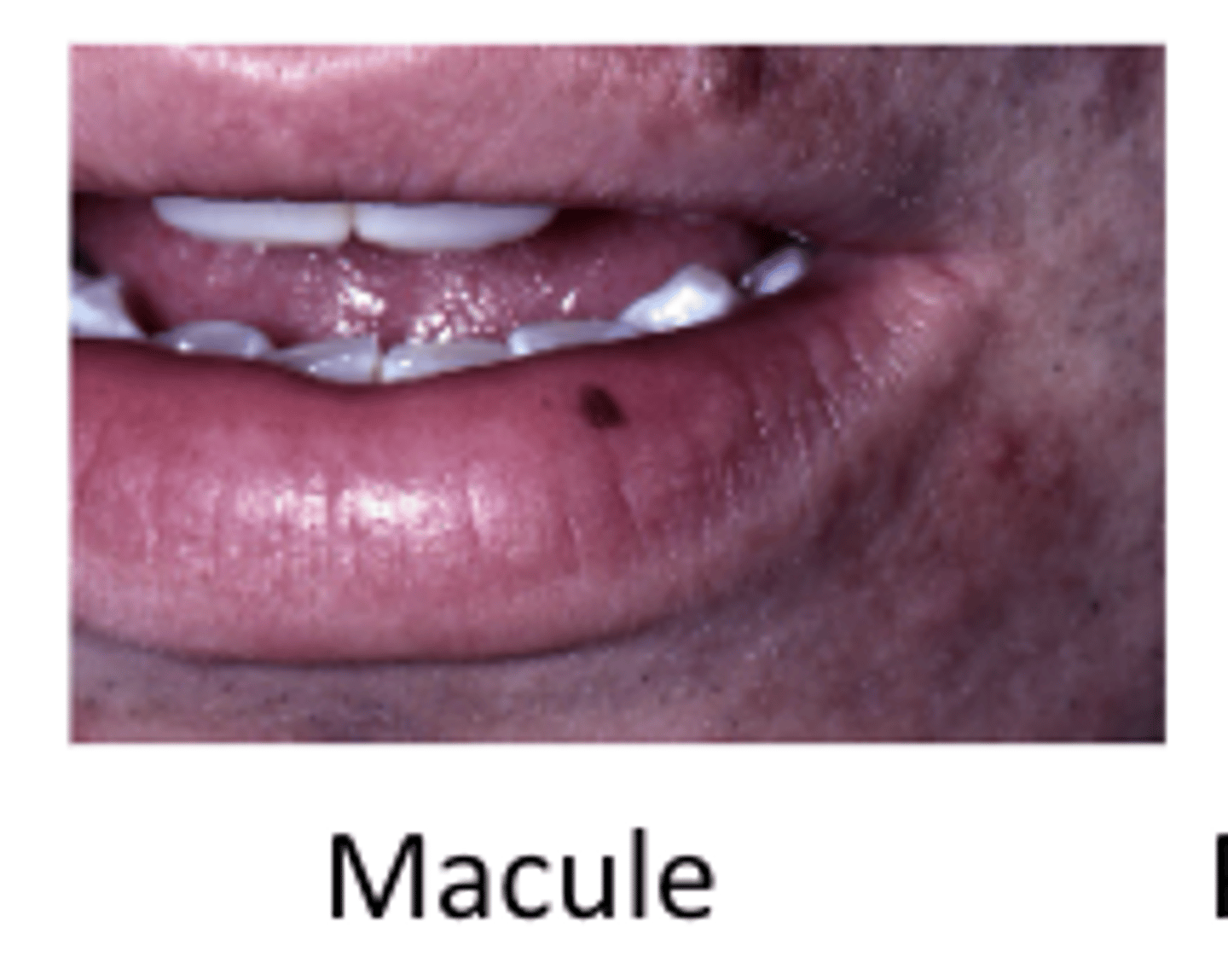 <p>flat lesion, pigmented</p>