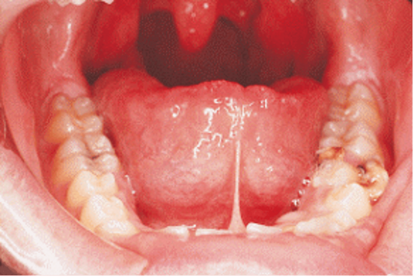 <p>Ankyloglossia (tongue tie)</p>