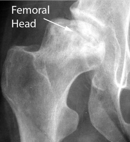 <p>What pathology is seen here?</p>