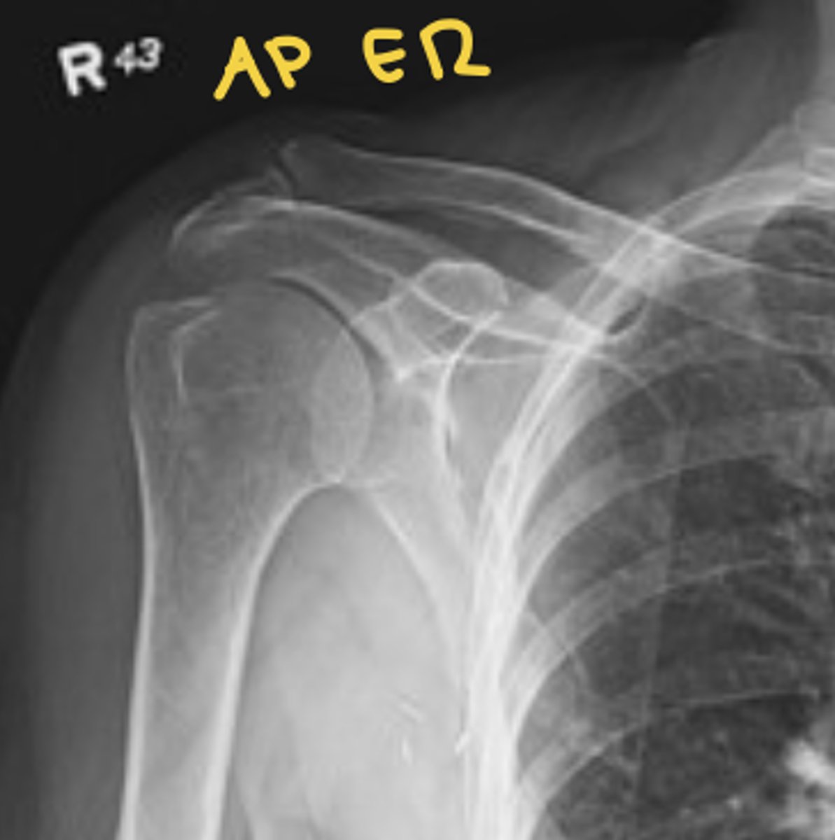 <p>see greater tuberosity</p>