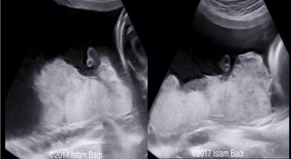 <p>a) normal grade 2 placenta</p><p>b) circumvallate placenta</p><p>c) placenta previa</p><p>d) placental abruption</p>