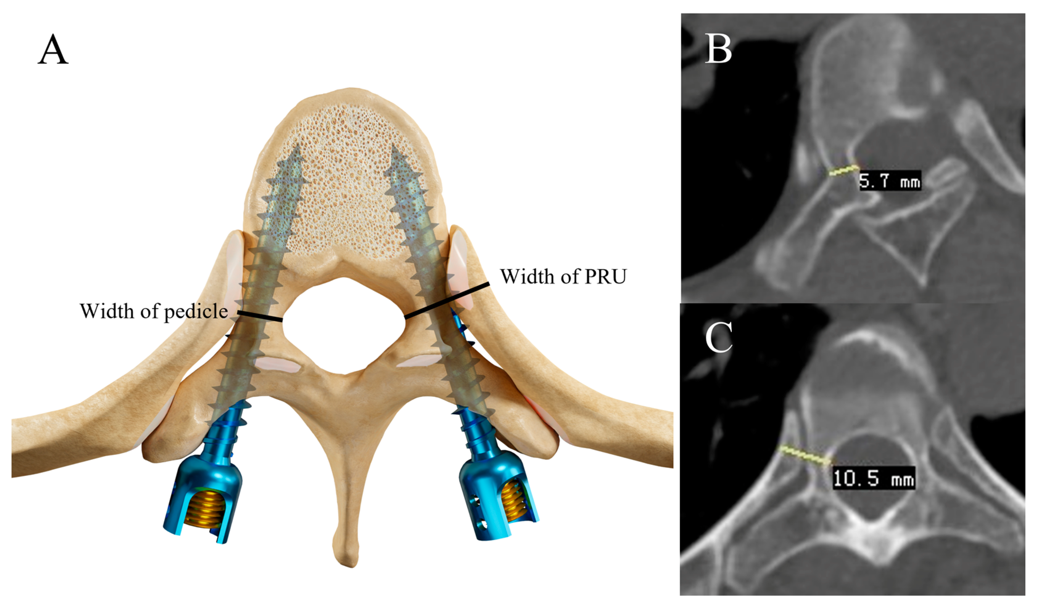 <p>pedicle screw fixation&nbsp;</p>