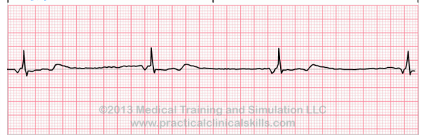 <p>What does this EKG show?</p>
