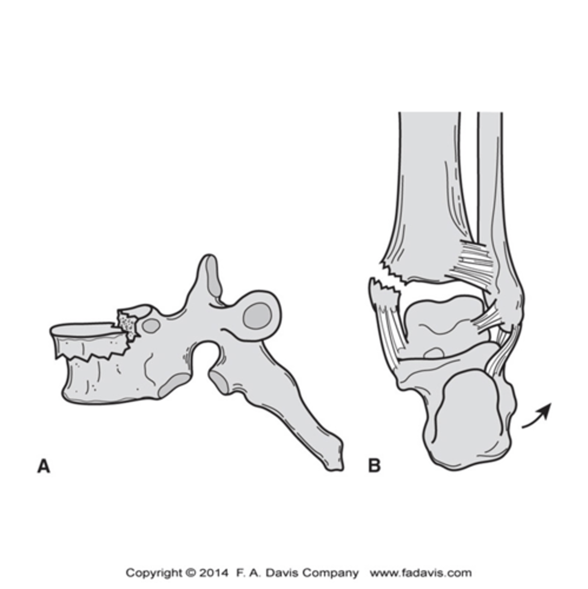 <p>Tensile loading of the bone from a muscle-tendon (active contraction) or passive resistance of a ligament against a tensile load</p>