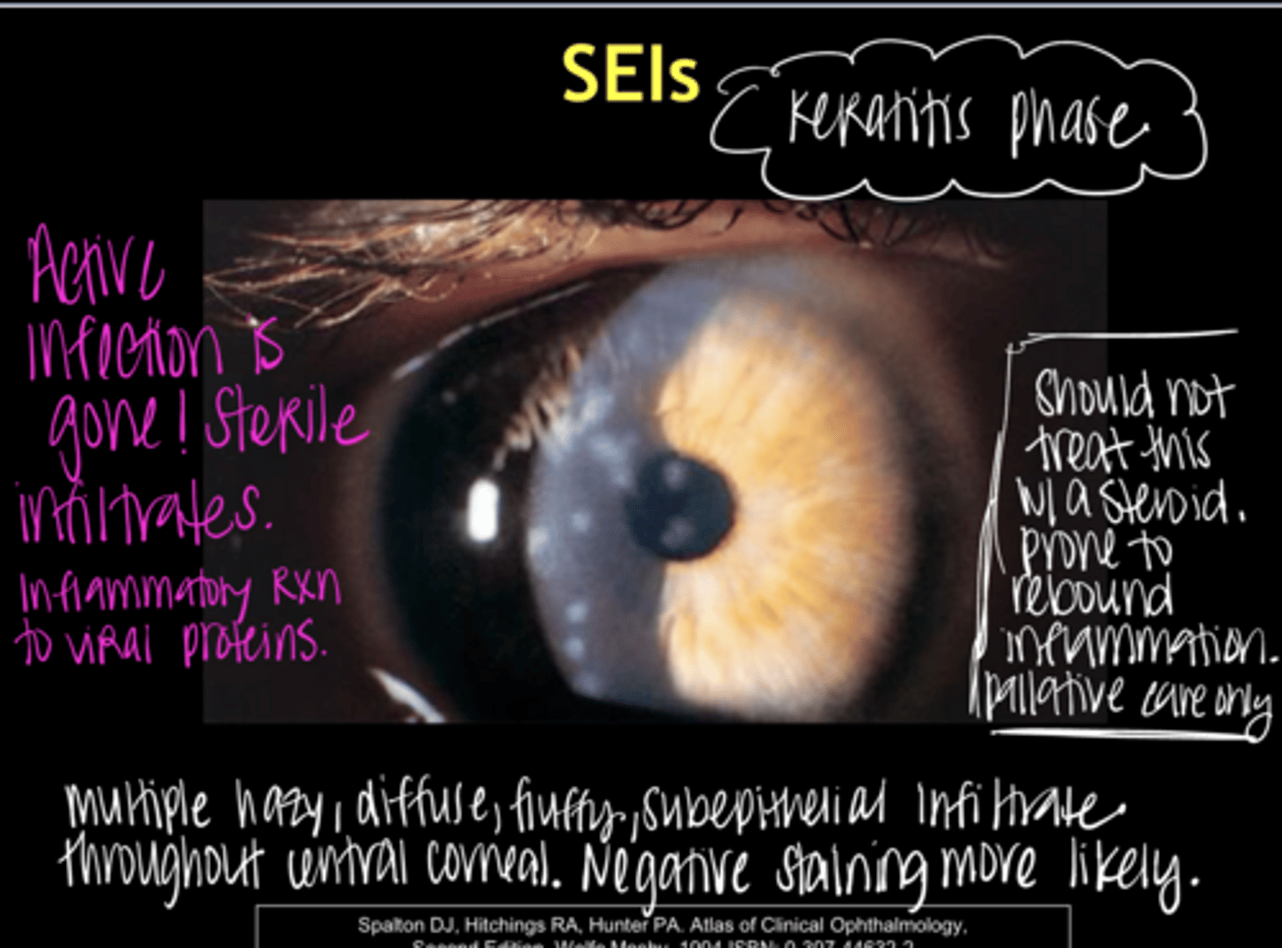 <p>Are subepithelial infiltrates (SEIs) common in EKC?</p>