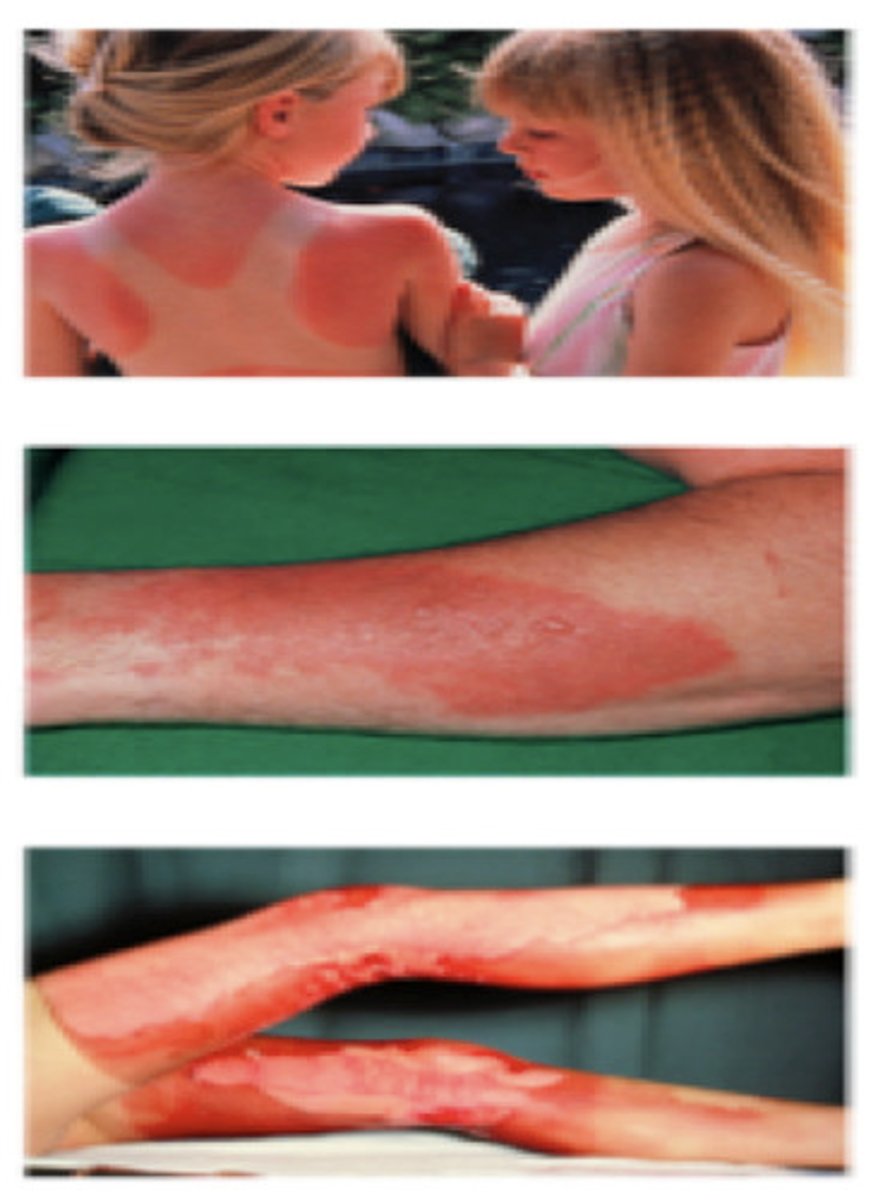 <p>Sunburn. Epidermis is damaged and is characterized by mild pain, redness but have normal skin fucntion.</p>