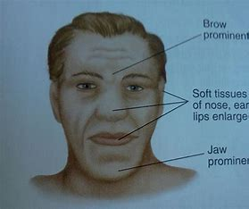 <p><span>= large, elongated bones, jaw, forehead, nose, &amp; lips</span></p><ul><li><p><span>possibly caused by a pituitary tumor bc of excessive secretion of GH</span></p></li></ul>