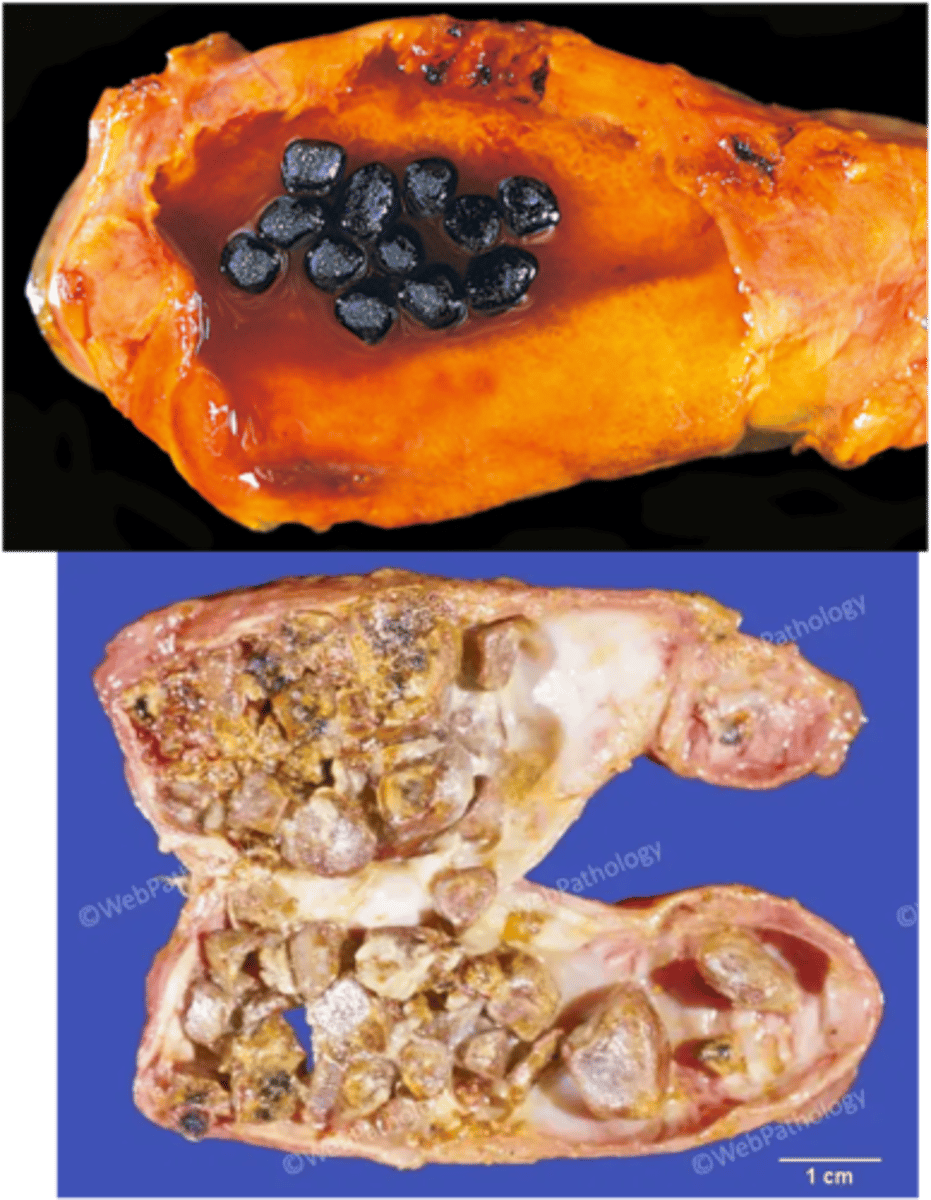 <p>Define Condition:</p><p>Stones from UCB in bile (insoluble in H2O)</p><p>-Hx:</p><p>&gt; Cirrhosis (less bile salts --&gt; less soluble bilirubin)</p><p>&gt; Crohn's Disease (Ileum inflammation --&gt; less bile salt reabsorb)</p><p>Black Stones</p><p>-Path: Chronic Hemolysis (HS and SCD = RBC Turnover)</p><p>&gt; Increased UCB --&gt; Calcium Bilirubinate</p><p>-Dx: Imaging</p><p>&gt; RADIOPAQUE d/t Calcium</p><p>Brown Stones</p><p>-Hx:</p><p>&gt; E. coli</p><p>&gt; Clonorchis sinensis</p><p>-Path: Infection</p><p>&gt; Increased Beta-glucuronidase --&gt; converts CB to UCB ==&gt; Calcium Bilirubinate + Increased FAs</p><p>-Dx: Imaging</p><p>&gt; RADIOLUCENT (Calcium SOAPS)</p><p>-Tx:</p><p>&gt; Cholecystectomy</p><p>&gt; Alternative = Ursodeoxycholic Acid (Bile Acid that causes less secretion of cholesteroll into bile; may dissolve cholesterol stones)</p><p>-Prog:</p><p>&gt; Biliary Colic</p><p>&gt; Choledocholithiasis</p><p>&gt; Acute/Chronic Cholecystitis</p><p>&gt; Porcelain gallbladder</p><p>&gt; Ascending/Acute Cholangitis</p><p>&gt; Gallstone Ileus</p>