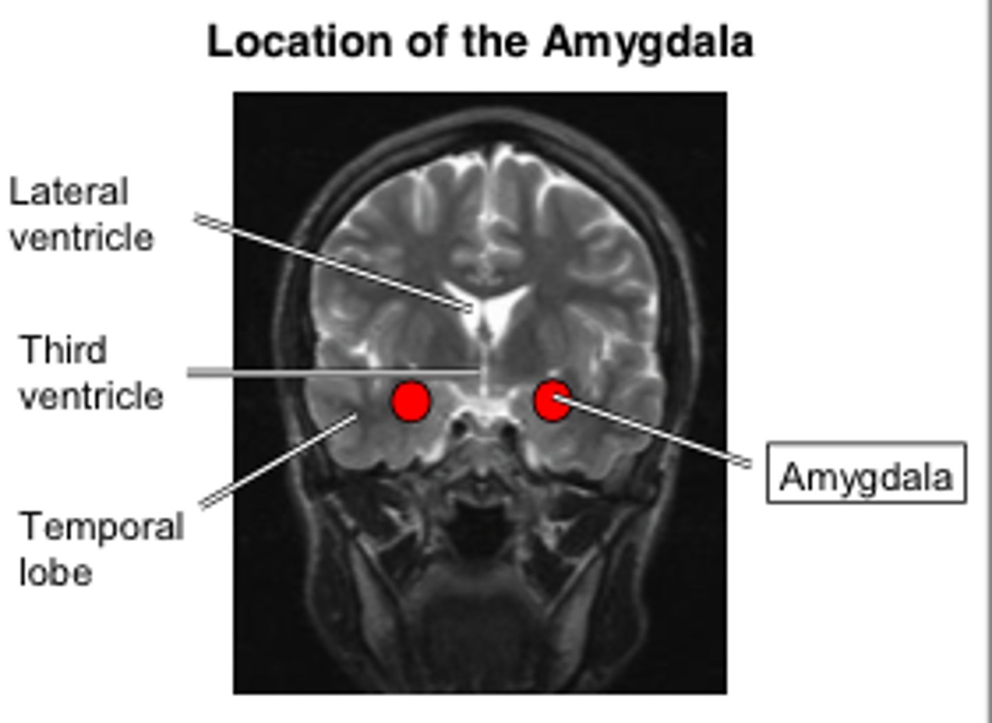 <p>Kluver-Bucy Syndrome</p><p>(bilateral amygdala lesion)</p>