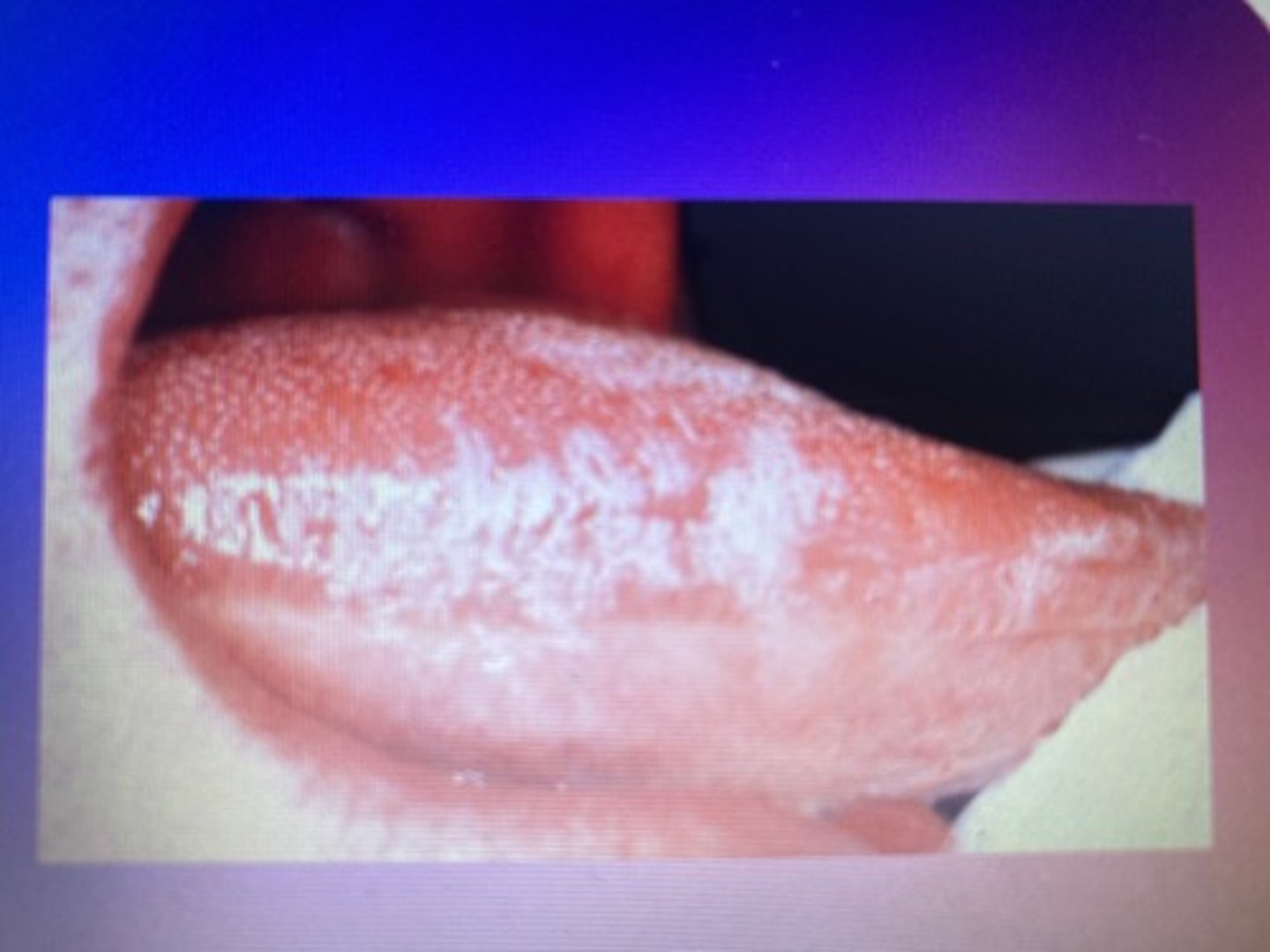 <p>This lesion is most likely caused by the Epstein-Barr virus.</p>