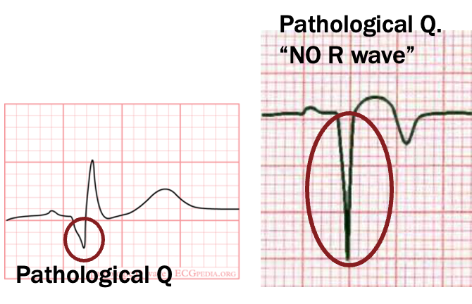 <p>longer than 0.04 s in duration (1 small box)</p><p>deeper than 2 mm or 2 small boxes</p><p>or deeper than 25% of height of R wave if present</p>