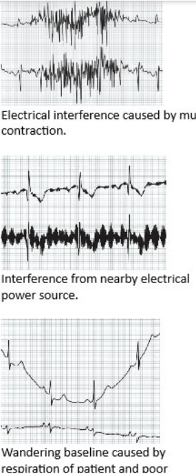 <ul><li><p>switch off non-essential electrical devices and equipment nearby</p></li><li><p>is the patient close to the machine power source? Try using battery power if possible</p></li><li><p>ensure cables aren’t tangled or in contact with metal objects/tables</p></li><li><p>all leads should NOT run across the machine</p></li><li><p>inspect wires and cables for cracks/damage</p></li><li><p>is filter on/off? - filter can help reduce interference from muscle, turn off for lead II (can lead to distortion of the waves)</p></li><li><p>ensure all connectors are attached to the machine</p></li><li><p>ensure all electrodes are attached properly</p><p><span> </span></p><p><span>Bottom image - caused by poor respiration of patient and poor electrode connection&nbsp;</span></p></li></ul><p></p>
