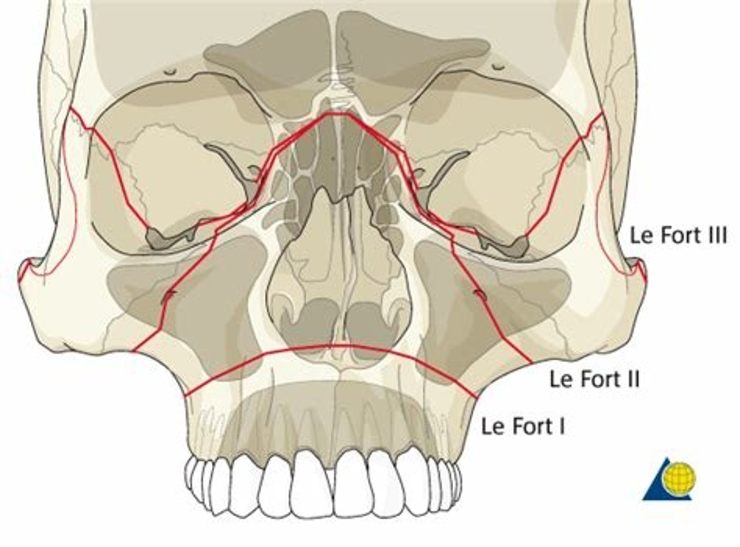<p>le fort</p>