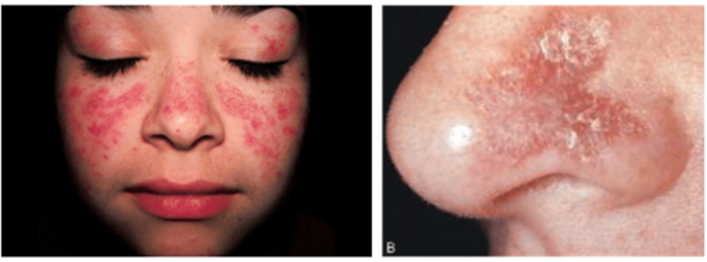 <p>butterfly rash on the bridge of the nose</p>