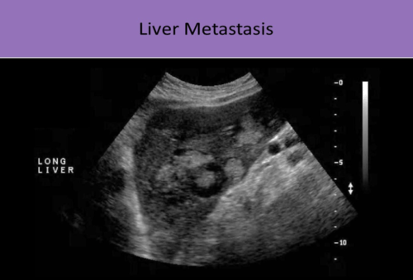 <p>1. LIVER IS #1 SITE<br>2. 20x MORE COMMON THAN PRIMARY LIVER CANCER<br>3. common primaries= GI TRACT (#1), PANCREAS, BREAST, LUNG, OVARY<br>4. primary cancers metastasized to the liver are carried by the PORTAL VEIN<br>5. contrast U/S will demonstrate rapid CONTRAST WASHOUT in the portal venous phase<br>6. sonographic appearance can suggest the origin of the primary tumor, but biopsy is required for diagnosis</p>