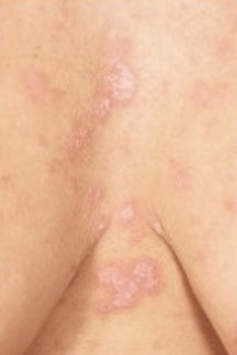 <p>Hiernaast zien we een afbeelding van een bepaald type squameus letsel (pytiriasis rosea) dit overeenkomt met een bepaald type schilfering, hoe heet dit?</p>