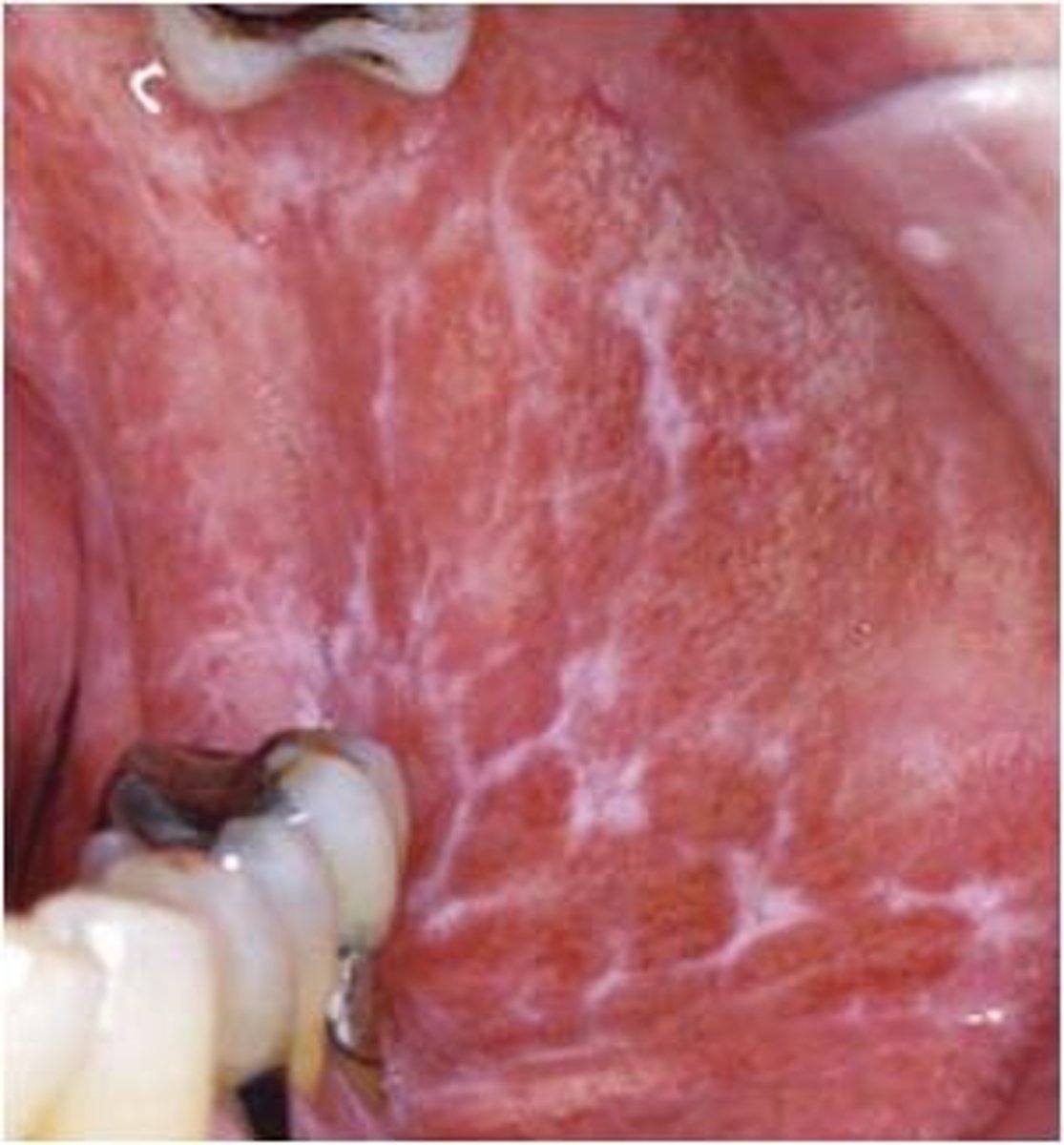 <p>diagnose this image</p><p>Purple (Violaceous), Polygonal, Pruritic, Papule w/ fine white lacy lines</p>