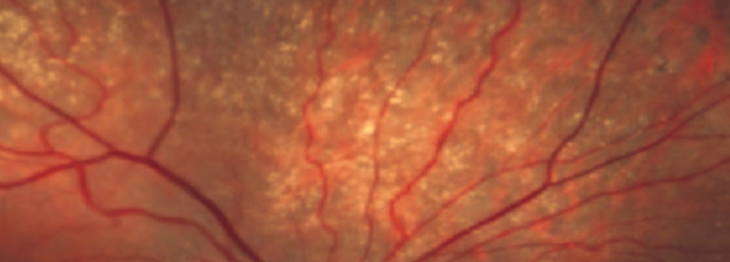 <p>Drusen of the peripheral retina can be seen with or without AMD associated with aging. Recent studies consider a potential association with these two conditions. However, this information is not diagnostically significant. Referral to PCP is indicated.</p>