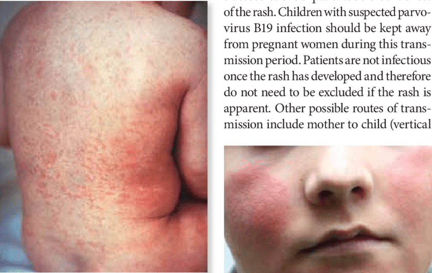 <p>macular rash 1-2 days after onset of prodromal fever -&gt; lasts 1-3 days, head, neck and trunk</p>