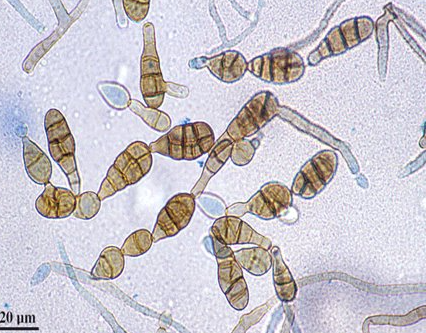<p>subcutaneous tissue, nails, eye, nasal sinus</p><p>DEMATIACEOUS MOLD (melanin in cell wall), not hyaline</p><p>dark gray, brown on front</p><p>black on back</p><p>conidia = large, muriform, bricklike arrangement, should be chains of 3!</p>